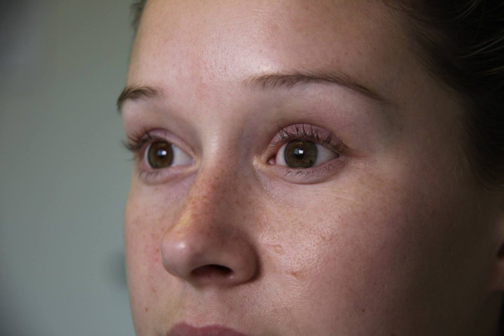 Do I need to Remove my Prosthesis Every Night? Ocularist John Stolpe